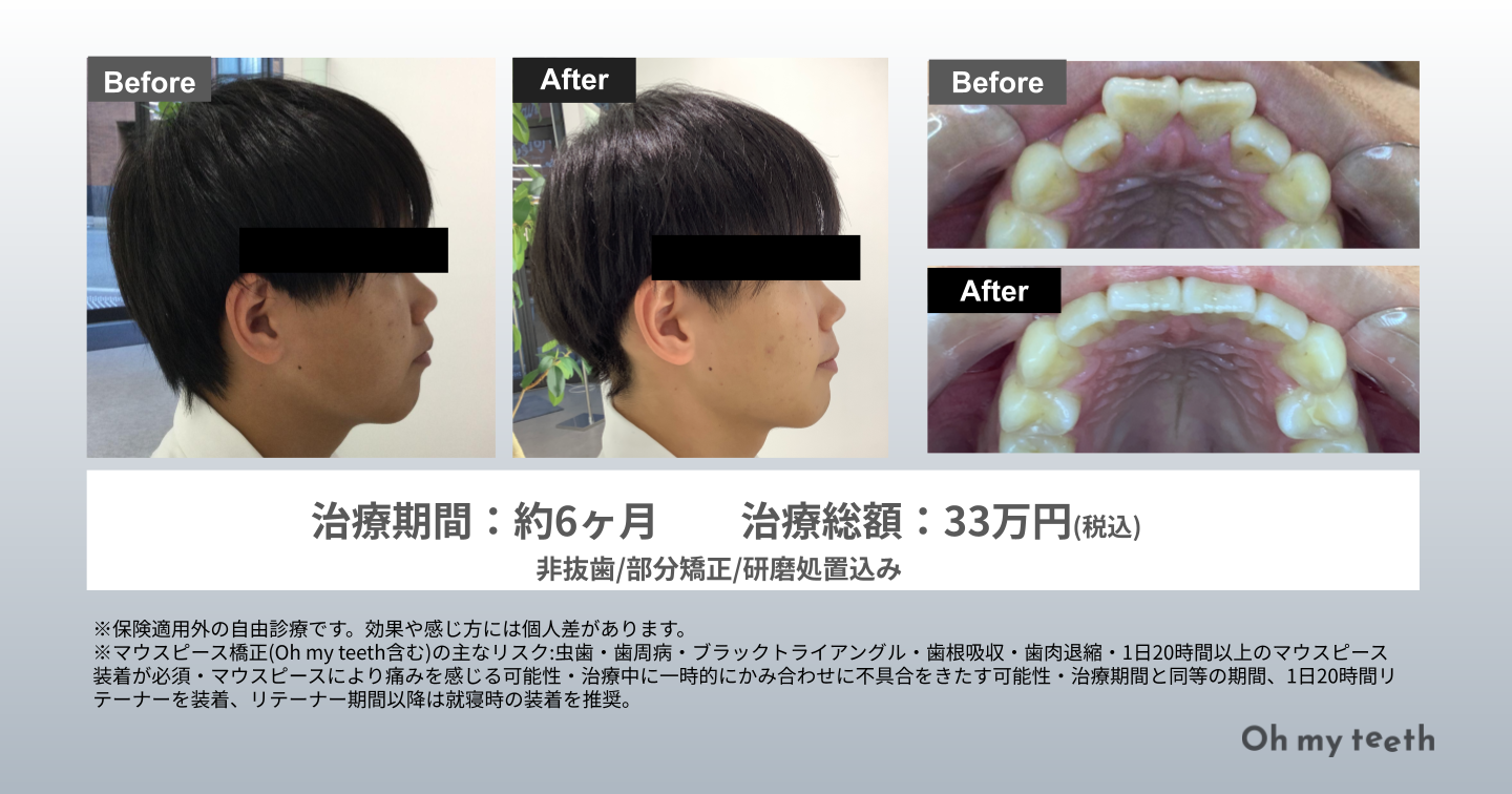 歯列矯正で顔貌はどう変わる？Eライン劇的変化の真相と後悔の理由