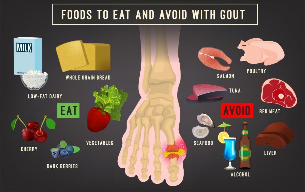 Foods to Avoid If You Have Gouty Arthritis