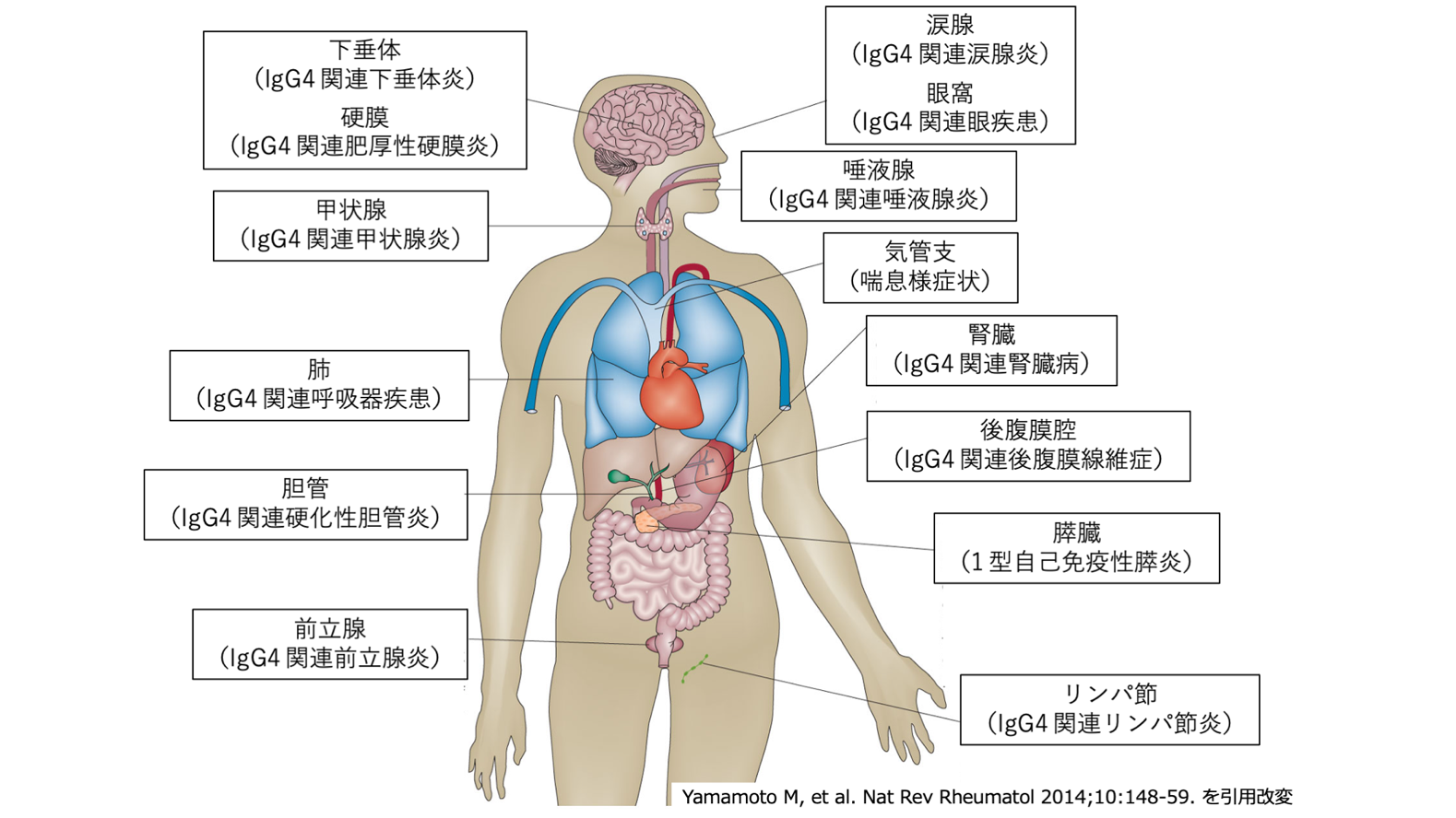 原因不明の腫れや不調の正体は？見逃せないIgg4関連疾患の真実