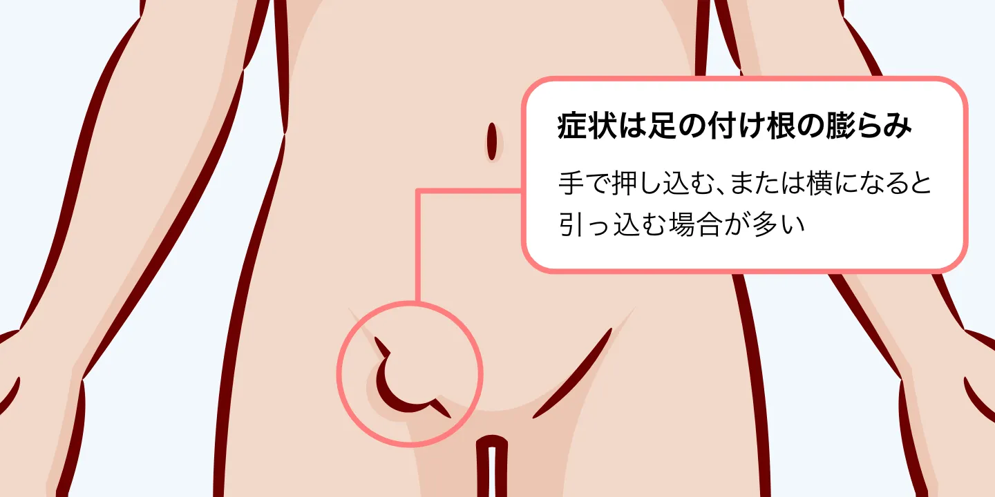 鼠径部のしこりは何科へ？痛くない放置が招く危機と男女別受診術