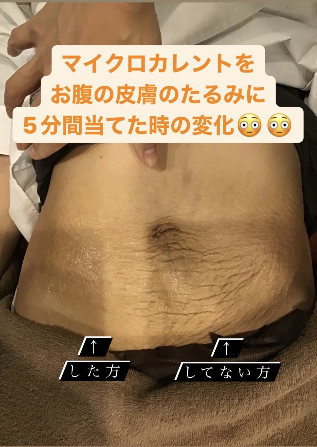 産後のお腹の皮たるみはなぜ戻らない？2026年最新の戻す方法と真実