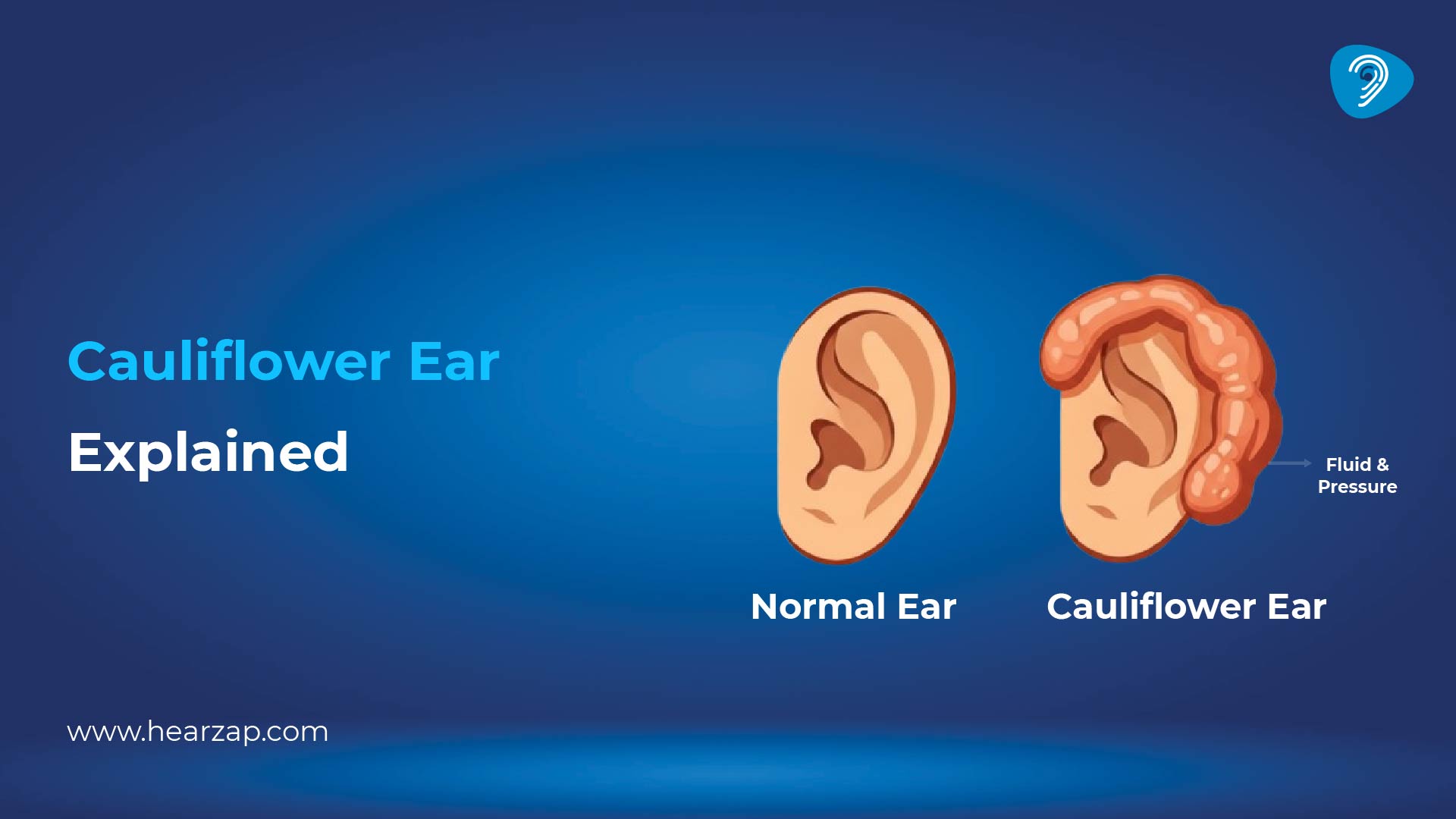 Is Cauliflower Ear Contagious