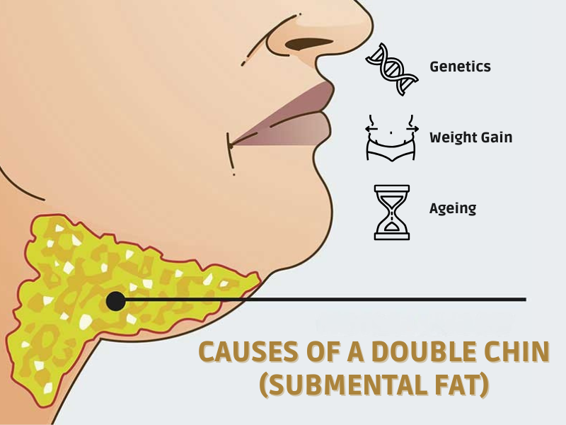 How Does a Double Chin Form