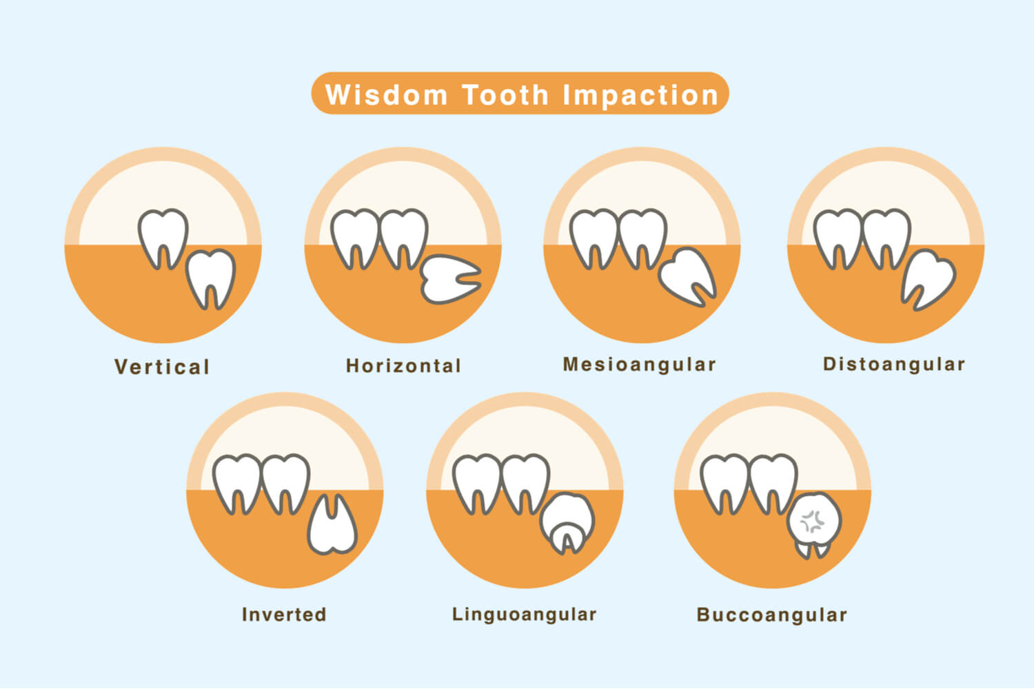 What Was the Original Purpose of Wisdom Teeth