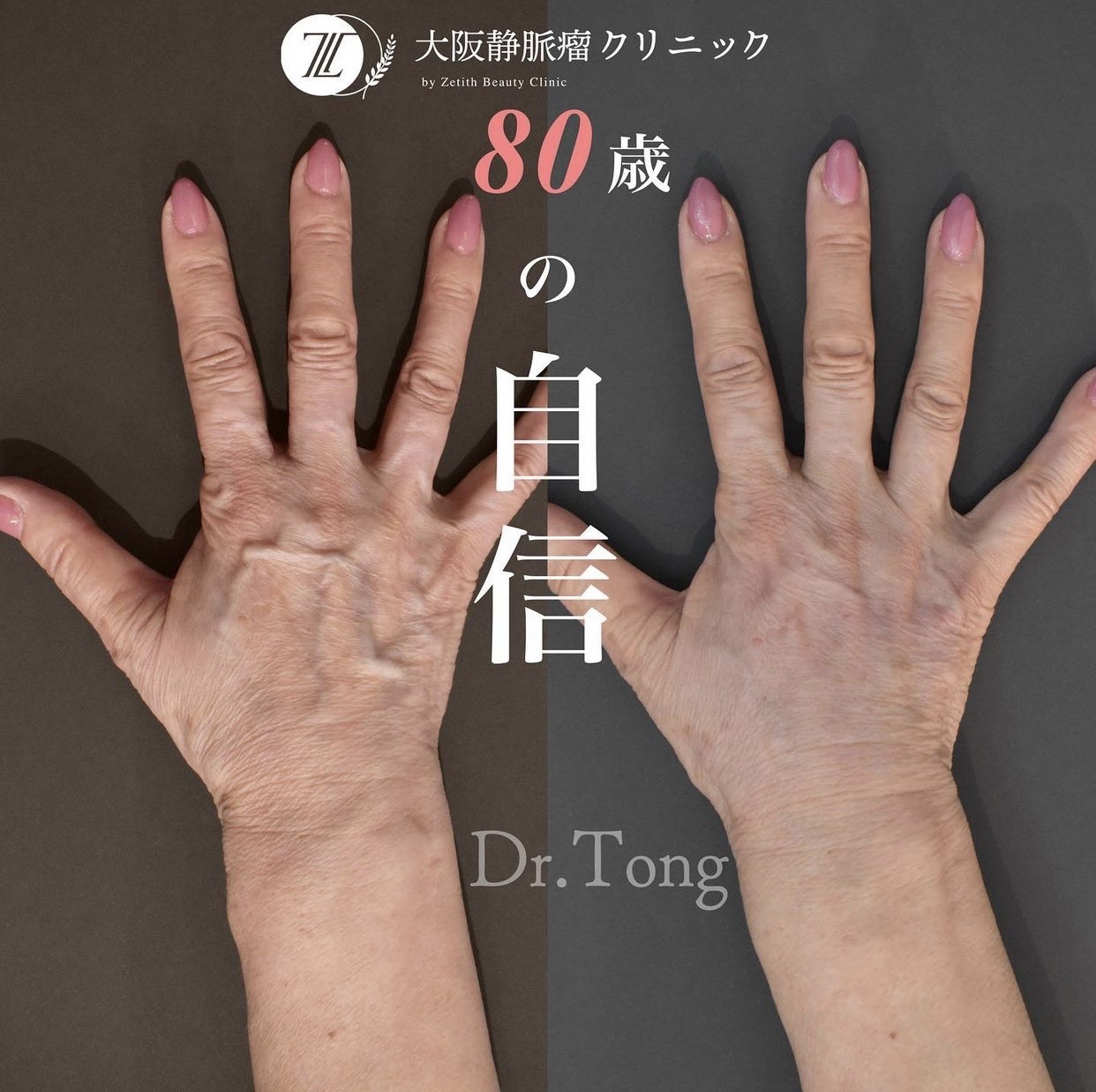 手の血管が浮き出る原因と病気のサイン｜専門医が明かす改善法と治療