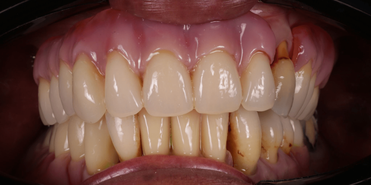 Day 2 After Immediate Dentures