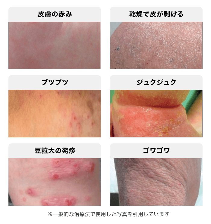 その肌荒れはアトピーかカビか？見分け方とステロイド悪化の真相
