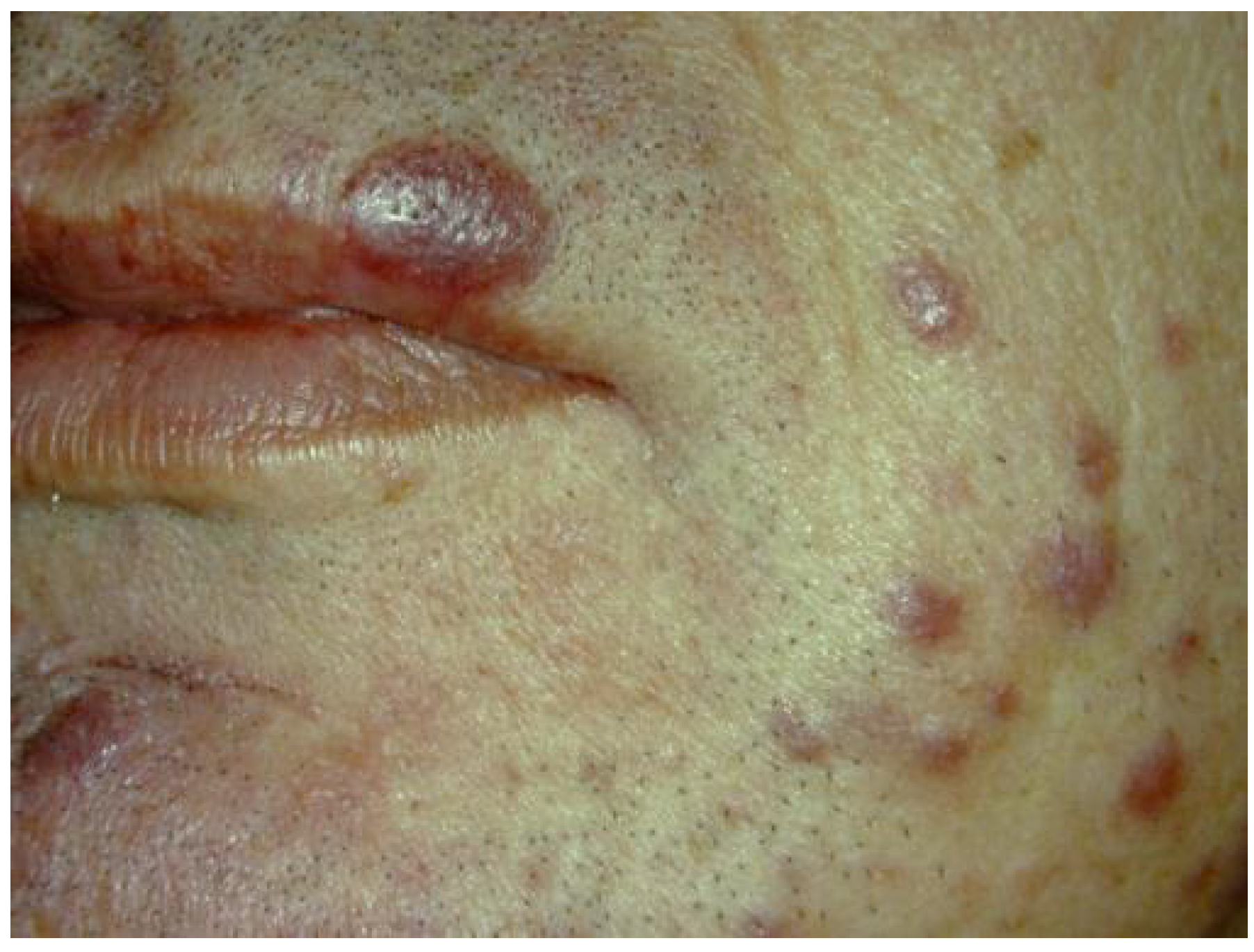 Lesions on the Face from Aids