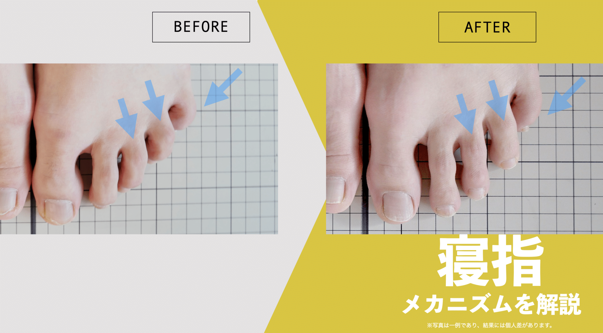 足の小指が倒れる寝指の治し方完全版｜原因と自宅改善法を徹底解説