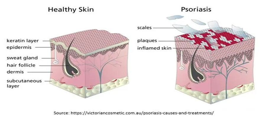 Can Psoriasis Spread